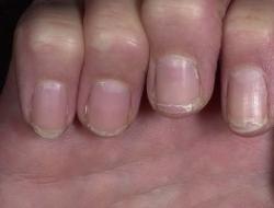 Ногти слоятся и ломаются: причины проблемы и лечение Слоятся ногти чем полечить